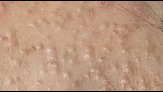 How to treat acne during pregnancy HoangMySpa122 [upl. by Aiseneg815]