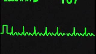 Atrial Flutter 31  ECG Simulator  Arrhythmia Simulator [upl. by Royden]