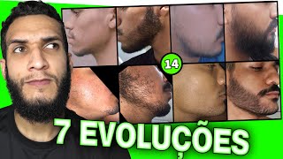 EVOLUÇÕES COM MINOXIDIL  7 evoluções 14 [upl. by Yrocal]