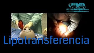 Todo lo que hay que saber de la lipotransferencia [upl. by Euqinobe]