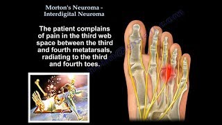 Mortons Neuroma  Interdigital Neuroma  Everything You Need To Know  Dr Nabil Ebraheim [upl. by Budwig743]