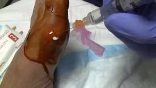 Gout and MTP Joint Arthrocentesis [upl. by Ishmul]