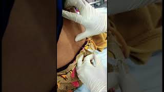 Cerebrospinal fluid CSF collection lumbar puncture procedure [upl. by Nyleak]