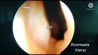 Complete Bicornuate Uterus on Hysteroscopy [upl. by Sihtam392]