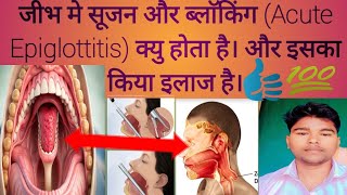 जीभ मे सूजन और ब्लाॅकिंग Acute Epiglottitis क्यु होता है। और इसका किया इलाज है। epiglottiris [upl. by Laved420]