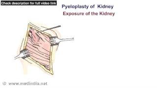 Pyeloplasty Of Kidney [upl. by Olvan]