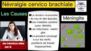 Névralgie Cervicobrachiale Conseils pour Soulager les Douleurs Arthrose cervicale Hernie discale [upl. by Berner]