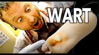 WORLDS LARGEST WART Frozen With Liquid Nitrogen  Dr Paul [upl. by Gipsy]