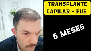 TRANSPLANTE CAPILAR  FUE 6 MESES  ESTOU SATISFEITO COM O RESULTADO [upl. by Aiduan]