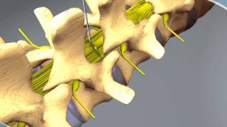 What to expect during an Epidural Steroid Injection at CDI in Orlando Florida [upl. by Alegnatal]