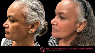 Dermamelan Peel Testimonial with Before and After Photos  Dr Shalini Gupta [upl. by Lytton83]