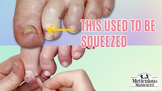 The Solution for Squeezed Toenail Problems [upl. by Franci]