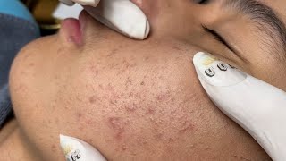 ACNE TREATMENT VU QUYNH MI Acne On Teens Cheek 2024 [upl. by Felic]