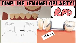 DIMPLING ENAMELOPLASTY II PROSTHETIC MOUTH PREPARATION II REMOVABLE PARTIAL DENTURE I PROSTHODONTICS [upl. by Allenod]