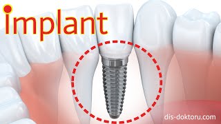 Baştan Sona İmplant Diş Tedavisi  Detaylı İmplant Yapımı  Nasıl Yapılır [upl. by Elden]