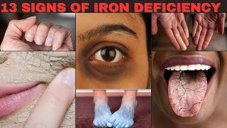 13 Shocking Signs of Iron Deficiency You Need to Know [upl. by Bornstein]