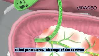 Choledocholithiasis explained [upl. by Shult]