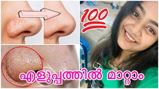 How to remove blackheads amp whiteheads easily at home in Malayalam 💯 [upl. by Akaenahs]