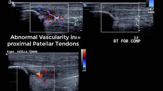 Knee Ultrasound basics  dynamic tests for anterior knee and ITB amp identifying collateral ligaments [upl. by Crandale]