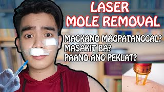 Mole Laser Removal 2024  Magkano magpatanggal ng nunal Masakit ba [upl. by Lladnarc]