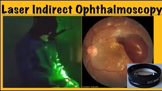 Laser indirect ophthalmoscopy [upl. by Ielhsa]