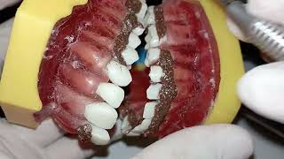 Uso de raspadores y curetas dentales [upl. by Craggy]