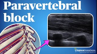 Ultrasound guided thoracic paravertebral block [upl. by Kira]