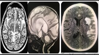 3neuroradiology spotters 15 cases in 15 minutes frcr radiopedia boardexamsmrictxrayanatomy [upl. by Ennylyak]