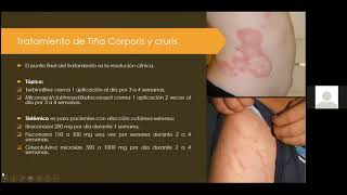 Micosis superficiales Dermatofitos [upl. by Aloke]