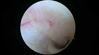 R knee medial mensectomy and chondroplasty 12 7 23 MT [upl. by Berkin734]