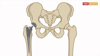 Prothèse de la hanche  lintervention [upl. by Aiekal]