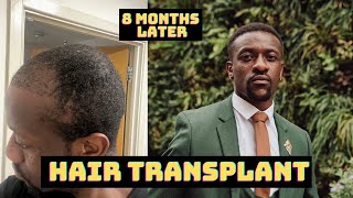 HAIR TRANSPLANT results after 8 months  Before amp After  Daniel Asante [upl. by Aicercal]