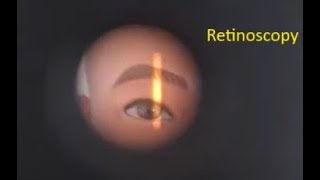 Retinoscopy Red Reflex Simplified [upl. by Nallak]