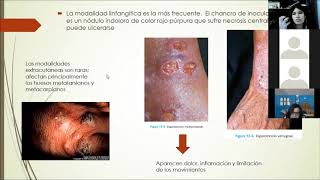 Micosis subcutaneas [upl. by Akcirderf522]