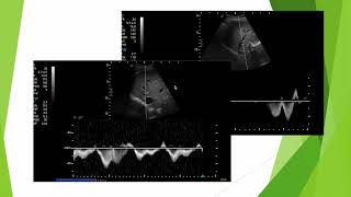 Doppler des veines sushépatiques flux monophasique de cirrhose [upl. by Bashemath496]