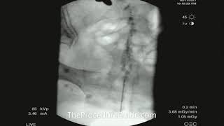 Fluoroscopic Caudal Epidural Contrast Spread [upl. by Grane]