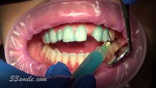 porcelain dental veneer bridge and veneers cosmetic dentistry before and after [upl. by Coryden342]