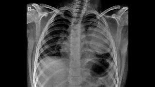 TMT LUNG OPACITY 10 YR OLD CHILD [upl. by Huston351]