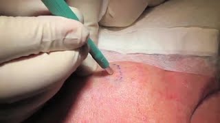 Punch Biopsy  Professor David Wilkinson  Professional Certificate of Skin Cancer Medicine [upl. by Hseyaj]