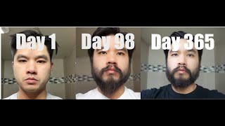 I Used Minoxidil For My Beard For 1 Year timeline [upl. by Nwahsauq732]