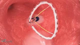 Valcare AMEND Transeptal Mitral Repair annuloplasty NF1021 [upl. by Thorne126]