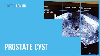 😲 Prostate cyst [upl. by Smail648]