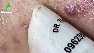 Satisfying SkinCare Blackheads Acne Extraction Video With Dr Thuy QGSPA Date Nov122024 [upl. by Debra680]