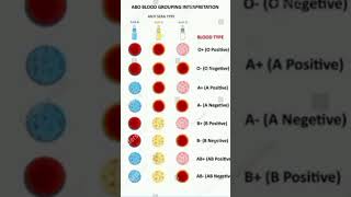 How to perform blood group test medicallaboratory [upl. by Jolyn]