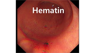 출혈성위염 아닙니다 Hematin 입니다 [upl. by Moneta]