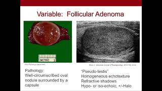 Thyroid Nodules What We Know and What We Dont Ultrasound Video [upl. by Ky]