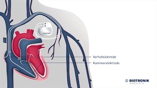 Herzschrittmacher Aufbau amp Funktion Animation Medizin [upl. by Aicia392]