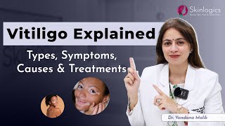 VitiligoLeucoderma  Causes and Treatment  Best Skin Specialist in Noida  Dr Vandana Malik [upl. by Gardell41]