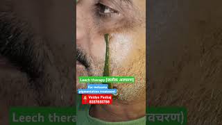 Melasma treatment ayurvedapigmentationleechtherapyskincareskinpanchakarmaviralvideoshortsmp [upl. by Orecic]