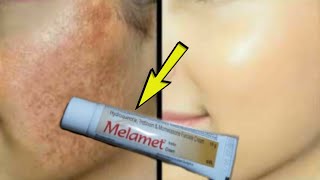 Melamet Cream How To Use  Detail Review in Hindi  Melamet Cream Remove Pigmentation  Melasma [upl. by Ayihsa814]